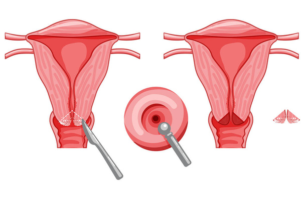 Rahim ağzı kanserinin termal pıhtılaşması kadın üreme sistemi Carcinoma uterus. Ön manzara. İnsan anatomisi iç organları konum şeması, rahim ağzı, fallop tüpü düz stil ikonu - Vektör, Görsel