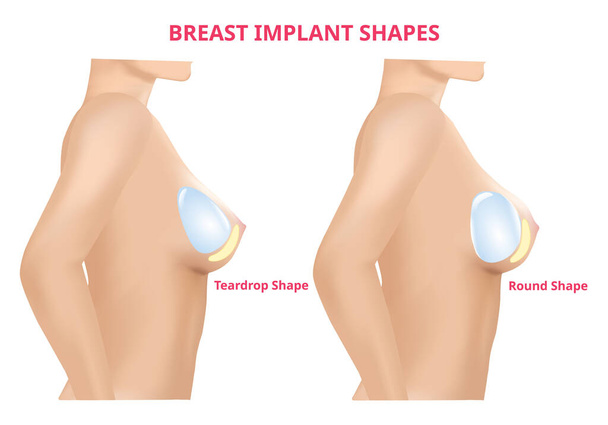 Okrągły kształt implantu piersi i kształt łzy, chirurgia piersi, 3D realistyczny projekt Vector. - Wektor, obraz