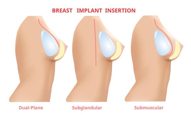 Inserimento protesi mammaria, Silicone per chirurgia mammaria, 3D Realistic design Vector
. - Vettoriali, immagini