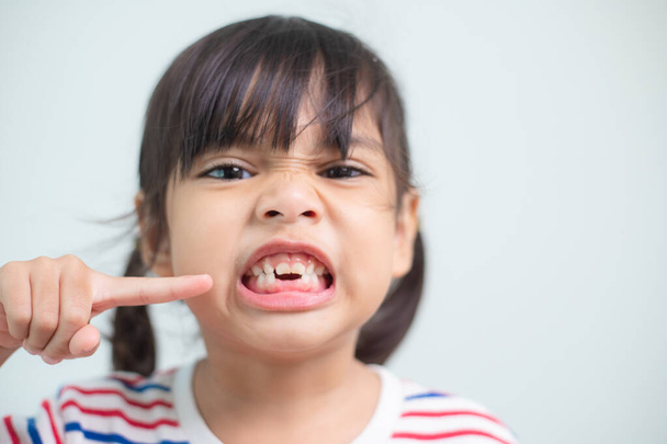 little Asian girl showing her broken milk teeth. - Foto, afbeelding