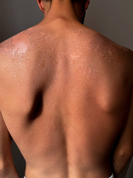 Peel back and shoulder skin from sunburn effect on young man body from sunbathing in summer - Fotoğraf, Görsel