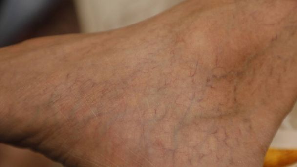 Κιρσώδεις φλέβες στο αρσενικό πόδι - Φωτογραφία, εικόνα