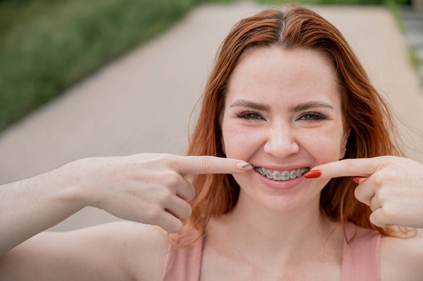 Young red-haired woman with braces on her teeth point to a smile outdoors in summer. - Fotoğraf, Görsel