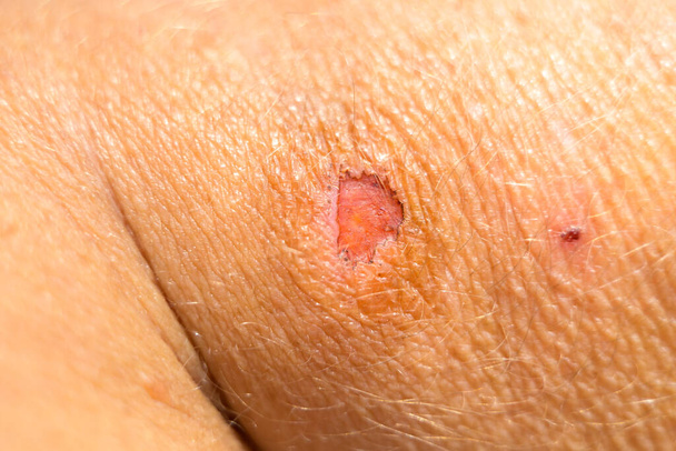 Close up of a healing soft tissue wound with surrounding trauma on a persons arm - Photo, Image