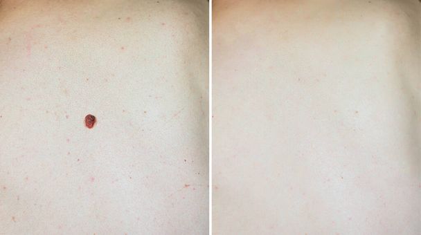 image of mole on man skin before after laser treatment - Photo, Image