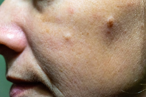 Close-up of a woman's cheek with problem skin. - Foto, Imagem