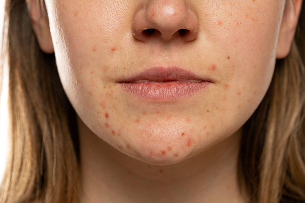 Egy fiatal nő pattanásokkal az arcán. Problémás bőr. Közelkép - Fotó, kép