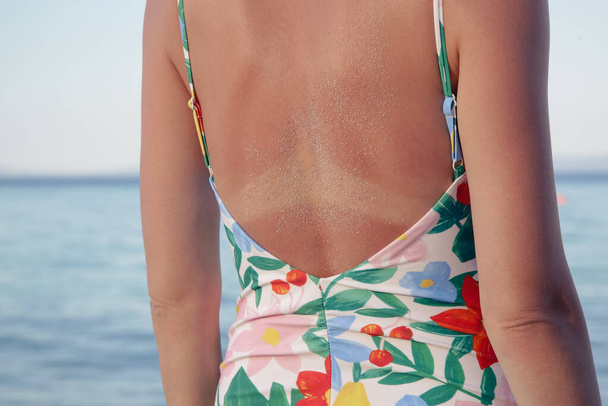 Close-up of a sunburn mark on woman's back - Foto, afbeelding