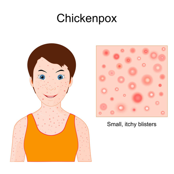 Chickenpox. Varicella. face of a child with skin rash. Close-up of skin with small, itchy blisters. Vector poster - Vektor, obrázek