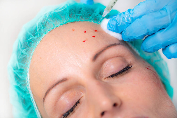 PRP Face Injection. Mid aged Woman Receives Platelet Rich Plasma Face Injection for Reduction of Skin Wrinkles - Foto, Bild