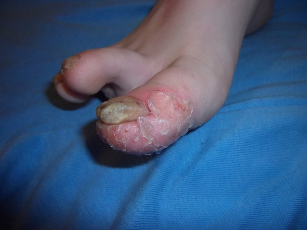 Psoriasis and mycosis baby toe - Photo, Image
