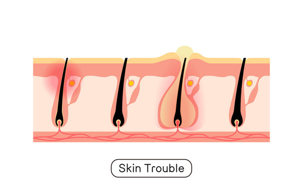 Image of hair removal, skin problems, rough skin from shaving hair yourself - Wektor, obraz