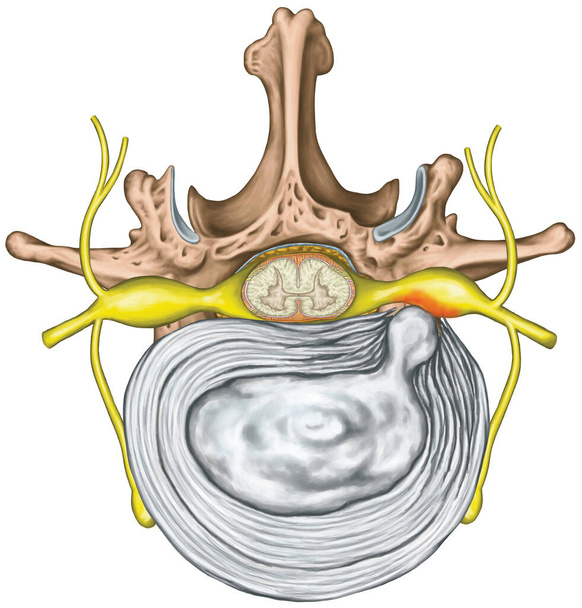 Lumbar disk herniation, herniated disc, lumbar vertebra, lumbar spine, intervertebral disk, nervous system, nerve root, spinal cord, vertebra, anatomy of human skeletal and nervous system, superior view - Zdjęcie, obraz