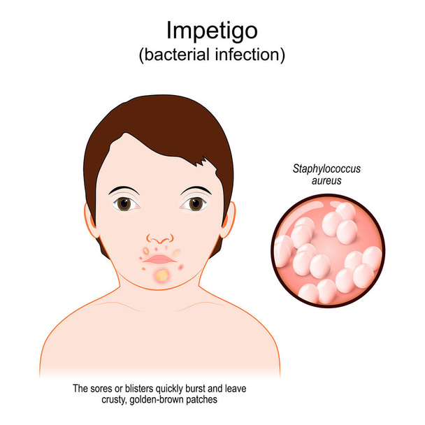 Impetigo. bakteriální infekce. Dítě s kožní infekcí kolem úst. Boláky nebo puchýře rychle prasknou a zanechají po sobě křupavé, zlatohnědé skvrny. Detailní záběr bakterie Staphylococcus aureus. Vektorový plakát - Vektor, obrázek