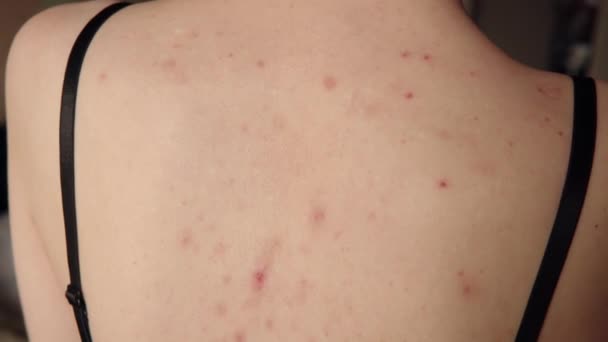 Close-up view of acne sequelae, torn pimples, skin itching on the back, dermatological problem. High resolution shot. - Πλάνα, βίντεο