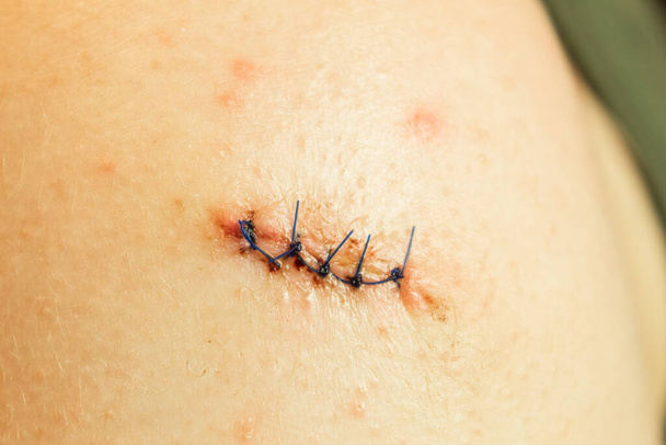 Stitched wound and medical suture, close-up. Medical sutures after operations, sewn surgical sutures on the human body. Medical and surgical care - Fotografie, Obrázek