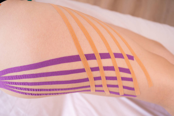 applying kinesiology tape to patient legs.Kinesiology taping. Anti-cellulite procedure for slim hips.Fat lose, cellulite removal. Weight loss concept. - Valokuva, kuva