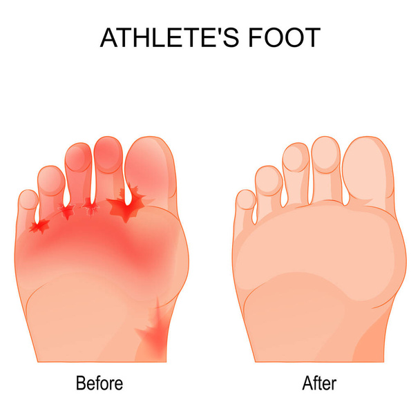 Athlete's foot is a fungal infection that affects the feet. Comparison and difference. Humans feet before and after therapy. vector poster - ベクター画像