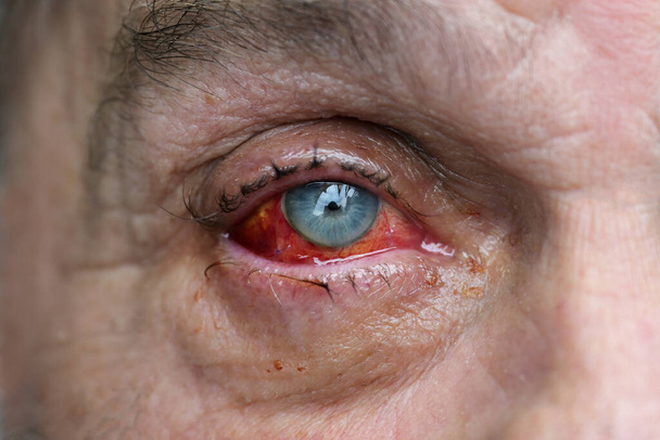 Eye of a man with injured conjunctiva due to an accident, sutured with several stitches and blood shot after surgery, health and medical theme, selected focus, narrow depth of field - Photo, image