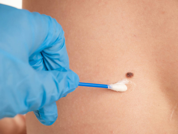 doctor examines the growths on the skin of an adult with a magnifying glass, diagnosis of skin cancer. Dermatologist examines the moles of the patient on a light background - Fotó, kép
