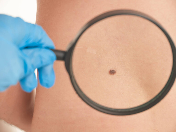 doctor examines the growths on the skin of an adult with a magnifying glass, diagnosis of skin cancer. Dermatologist examines the moles of the patient on a light background - Foto, Imagen