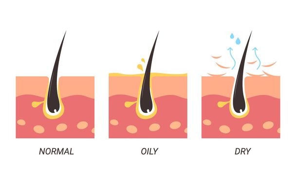 Normal, oily, and dry pores illustration - Vector, Image