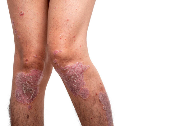 Psoriasis is that knee on white background. - Photo, Image