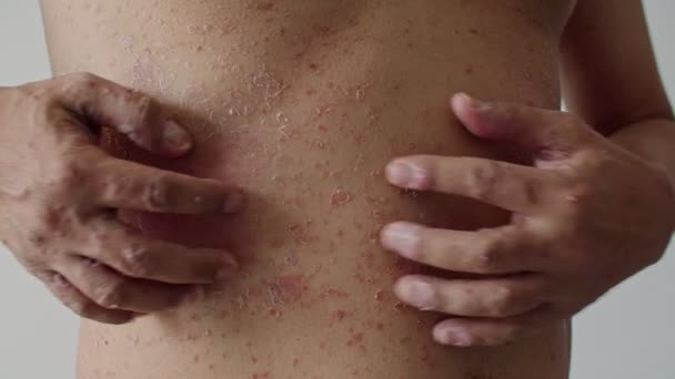 Psoriasis is the abdomen on white background. 4K Slow Motion - Filmmaterial, Video
