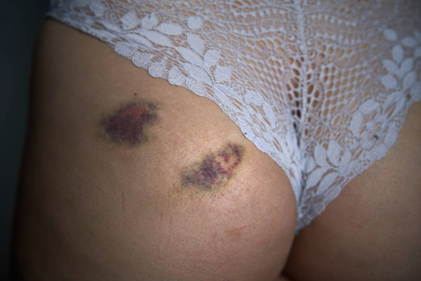 Injury on the skin after a fall. Hematoma on a woman's buttock. - Foto, immagini