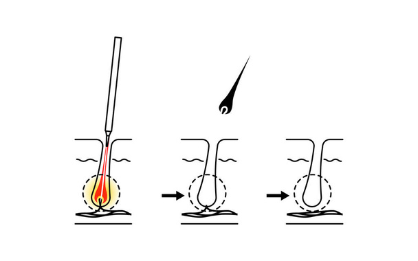 Afbeelding van ontharing, het proces van ontharing na naald ontharing behandeling - Vector, afbeelding