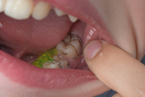 Mandibular plate, boy wearing teeth aligner, teeth and plate in detail. - Фото, изображение