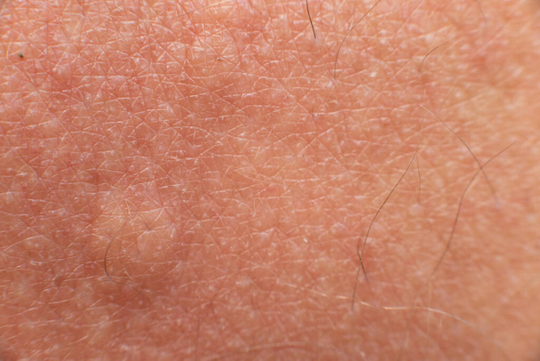 Swollen bee sting site, redness on the skin from a bee sting, close-up of the sting site. - Fotoğraf, Görsel