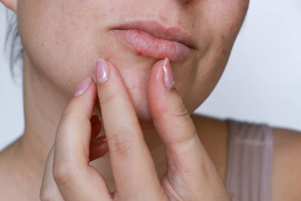 close up φυσικό γυναίκα κακή ακμή δέρμα με ουλές - Φωτογραφία, εικόνα