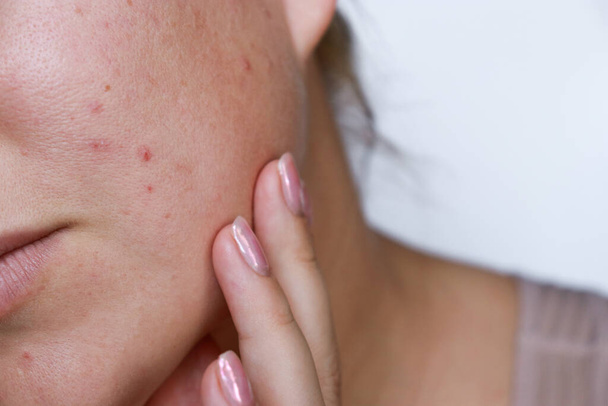 close up natural woman bad acne skin with scars - Fotoğraf, Görsel