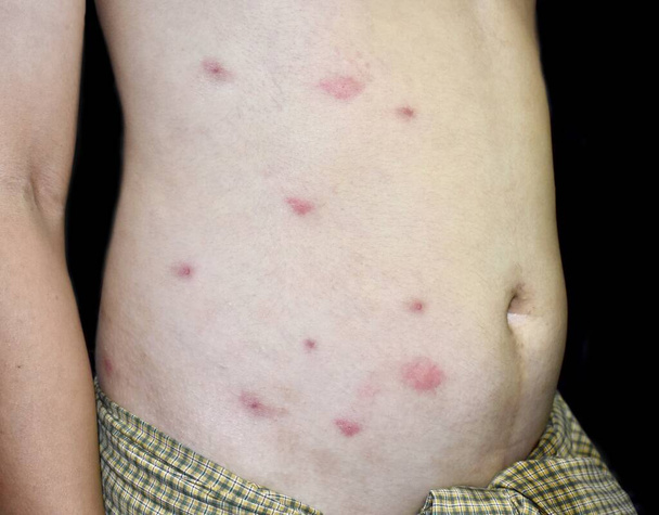 Multiple itchy mosquito or insect bite wheals; red spots on trunk of Southeast Asian, Chinese adult young man. Isolated on black background. - Foto, Imagem