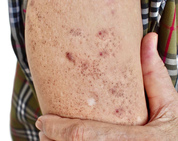 Age spots and white patches on arm of Asian elder man. These age spots are brown, gray, or black spots and also called liver spots, senile lentigo, solar lentigines, or sun spots. - Fotografie, Obrázek