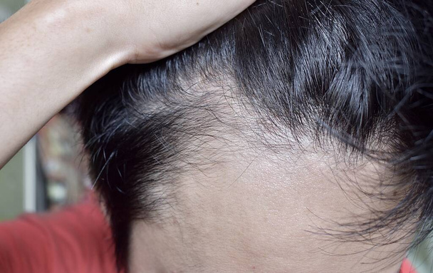 Thinning or sparse hair, male pattern hair loss in Southeast Asian, Chinese young man. - Foto, immagini