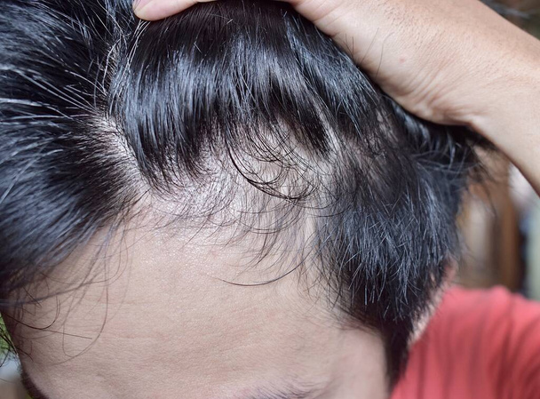 Thinning or sparse hair, male pattern hair loss in Southeast Asian, Chinese young man. - Foto, Imagen