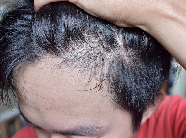 Thinning or sparse hair, male pattern hair loss in Southeast Asian, Chinese young man. - 写真・画像