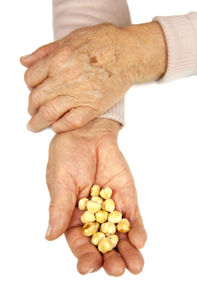 revmatoidní artritida rukou - Fotografie, Obrázek