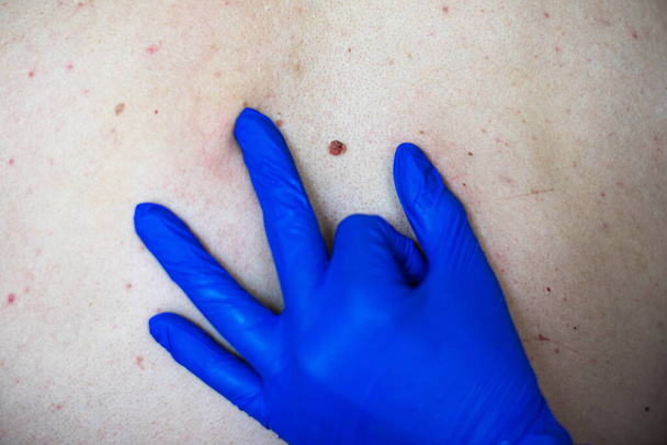 a doctor in blue gloves examines a large birthmark on man`s back. concept of cosmetic surgery. close up - Photo, Image