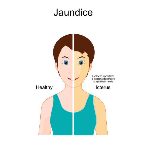 Jaundice. The Comparison between Healthy person and person with Icterus. yellowish pigmentation of the skin and sclera due to high bilirubin levels. health problems. vector illustration - Vektor, Bild