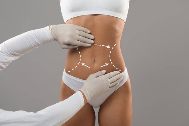 Body Contouring Concept. Unrecognizable Doctor Wearing Gloves Touching Female Body With Marked Lines In Abdomen Zone, Woman Patient Preparing For Liposuction Plastic Surgery, Cropped Shot - 写真・画像