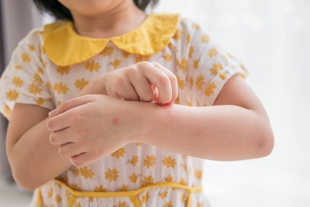 Little girl has skin rash allergy itching and scratching on her arm - Zdjęcie, obraz