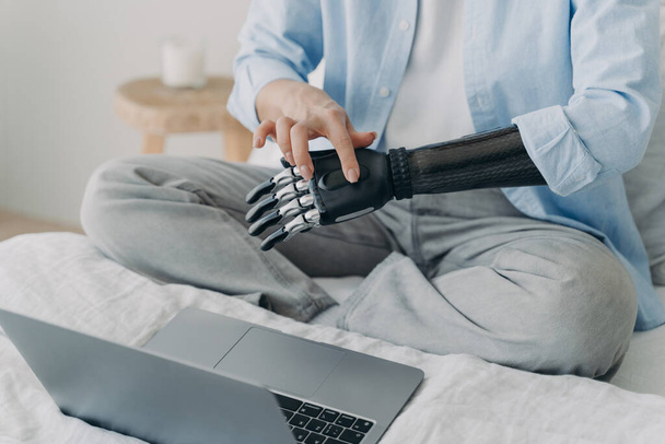 Handicapped european woman with artificial arm working on laptop at home. Freelancer is setting up her bionic prosthesis for work. Hands of disabled girl are typing on keyboard. - Foto, afbeelding
