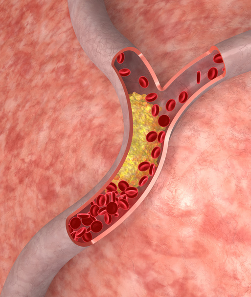 Cholesterol in artery - Photo, Image