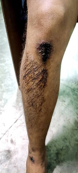The boy was in an accident with a knee injury. The wound should be cleaned to prevent serious infections. - Photo, image