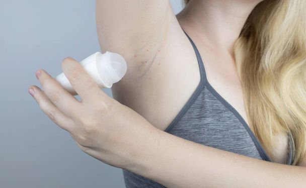 Armpit rash. Underarm skin irritation. Blonde girl shows irritation on the skin after using a razor, trimmer, deodorant or antiperspirant. Allergy or irritation. Acne or red spots - Fotó, kép