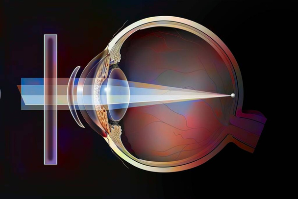 Various possible corrections on an astigmatic eye: spectacle lenses, external lenses. - Fotoğraf, Görsel