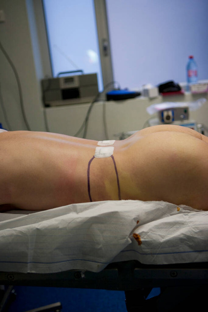 Cosmetic surgery, liposuction, aspiration of fat by a pump. - Foto, immagini
